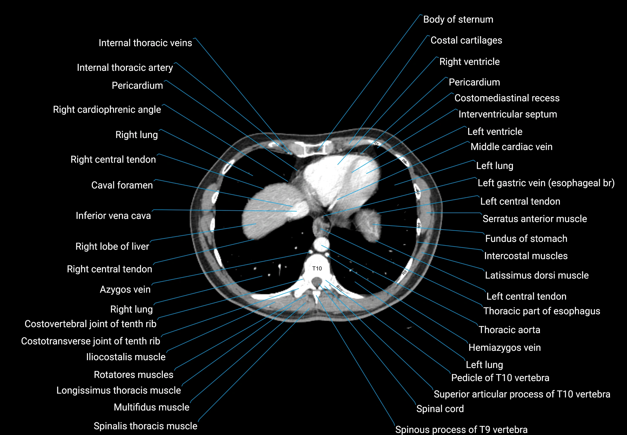 CT male pelvis axial cross sectional anatomy labelled radiology image -00011.webp